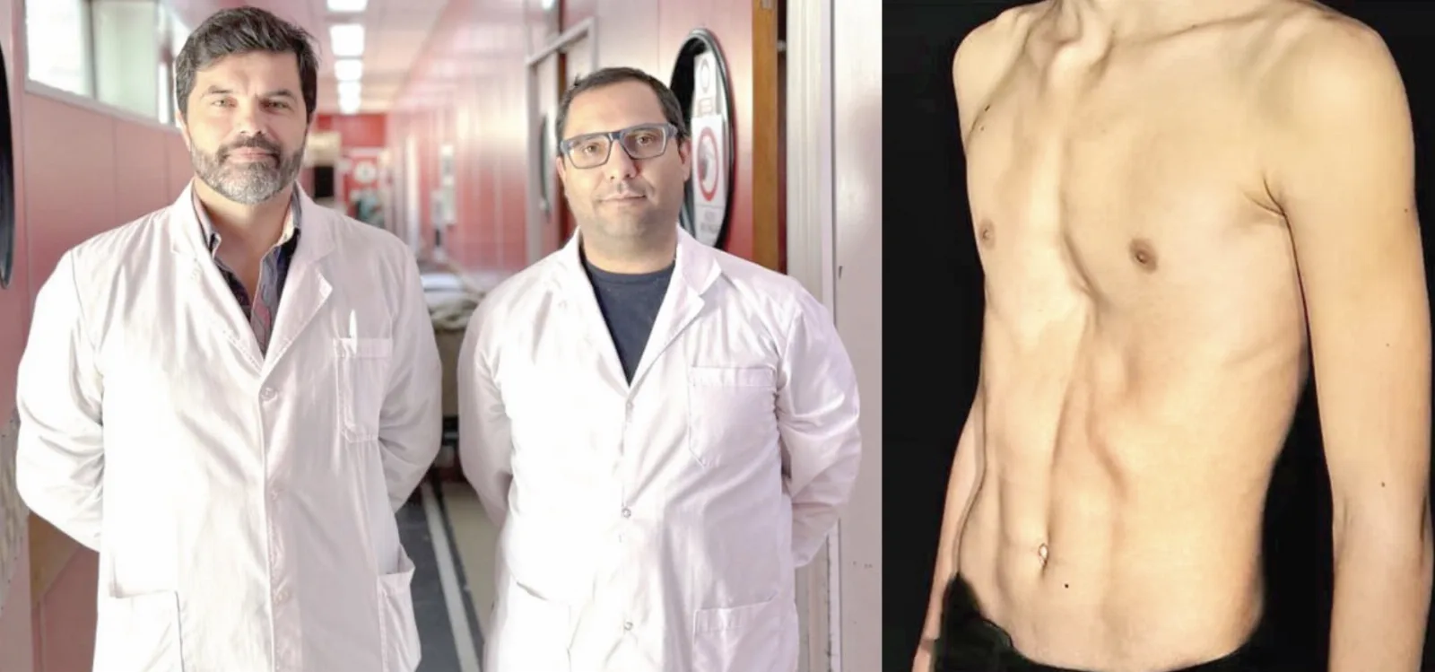 Logro médico en el HRU: operaron con éxito a un adolescente de 14 años con pectus excavatum